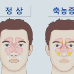 만성 부비동염(축농증) 원인, 치료, 수술 등 안내 5