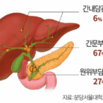 담도암 증상, 원인, 검사 및 진단 소개 5