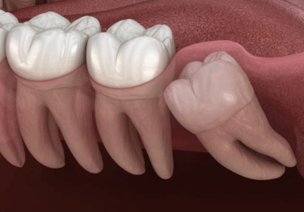 사랑니 발치비용 발치시기 치과 매복 발치 건강보험 적용 3