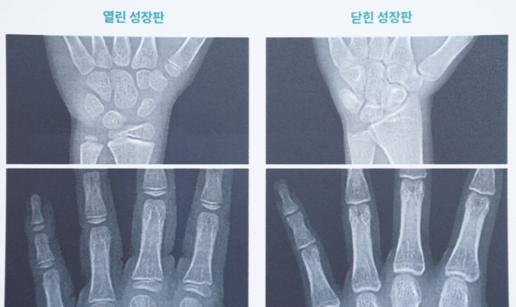 성장판 검사비용 실비청구 비급여 의료보험 적용 키성장 검사시기 검사연령 나이 2