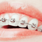 치아교정 비용 교정기간 줄이는 법 교정종류 치과치료 7