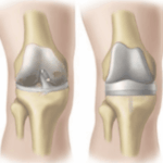 무릎 인공관절 수술 비용 회복기간 수술나이 수술후기 주의사항 7
