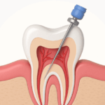 신경치료 관련 질문사항 정리 충치치료 치과치료 바로알기 4